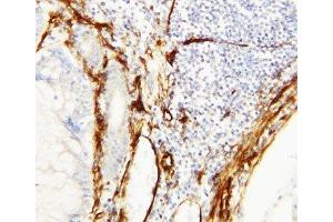 IHC-P: Caveolin-1 antibody testing of human breast cancer tissue (Caveolin-1 antibody  (C-Term))
