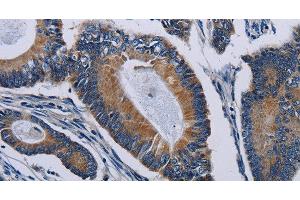 Immunohistochemistry of paraffin-embedded Human colon cancer tissue using PCDHAC2 Polyclonal Antibody at dilution 1:50 (PCDHAC2 antibody)