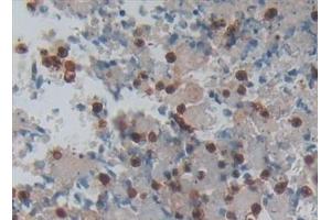 Detection of PP13 in Human Lung cancer Tissue using Polyclonal Antibody to Placental Protein 13 (PP13) (LGALS13 antibody  (AA 1-139))