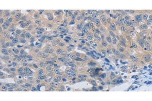 Immunohistochemistry of paraffin-embedded Human ovarian cancer using MMP8 Polyclonal Antibody at dilution of 1:45 (MMP8 antibody)