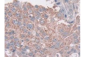 Detection of CXADR in Human Breast cancer Tissue using Polyclonal Antibody to Coxsackie Virus And Adenovirus Receptor (CXADR) (Coxsackie Adenovirus Receptor antibody  (AA 20-229))