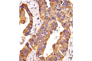Antibody staining MMP14 in human lung adenocarcinoma tissue sections by Immunohistochemistry (IHC-P - paraformaldehyde-fixed, paraffin-embedded sections). (MMP14 antibody  (N-Term))