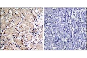 Immunohistochemistry analysis of paraffin-embedded human breast carcinoma, using FKHR (Phospho-Ser319) Antibody. (FOXO1 antibody  (pSer319))