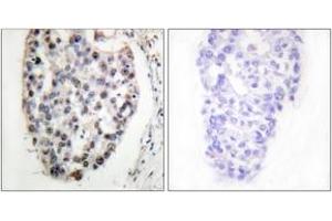 Immunohistochemistry analysis of paraffin-embedded human breast carcinoma tissue, using MYF5 (Ab-49) Antibody.