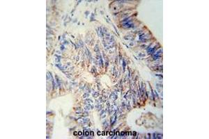 B3GNT6 Antibody (Center) immunohistochemistry analysis in formalin fixed and paraffin embedded human colon carcinoma followed by peroxidase conjugation of the secondary antibody and DAB staining. (B3GNT6 antibody  (Middle Region))