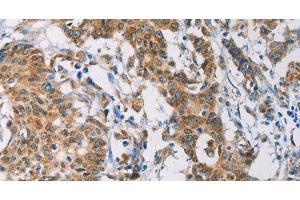 Immunohistochemistry of paraffin-embedded Human gastric cancer tissue using CERK Polyclonal Antibody at dilution 1:30 (CERK antibody)