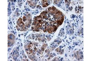 Immunohistochemical staining of paraffin-embedded Carcinoma of liver tissue using anti-DCXRmouse monoclonal antibody. (DCXR antibody)