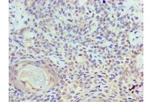 Immunohistochemistry of paraffin-embedded human breast cancer using ABIN7150350 at dilution of 1:100 (TOPBP1 antibody  (AA 1253-1522))