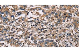 Immunohistochemistry of paraffin-embedded Human liver cancer using HSD17B12 Polyclonal Antibody at dilution of 1:30 (HSD17B12 antibody)