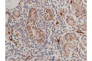 ABIN6269175 at 1/200 staining human breast cancer tissue sections by IHC-P. (FLT1 antibody)