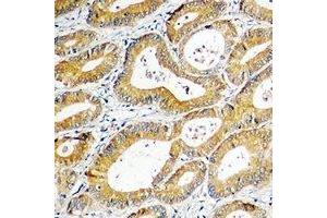 Immunohistochemical analysis of SGK1 staining in human colon cancer formalin fixed paraffin embedded tissue section.