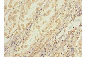 Immunohistochemistry of paraffin-embedded human gastric cancer using ABIN7148092 at dilution of 1:100 (CCDC15 antibody  (AA 1-245))
