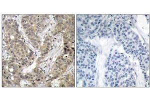Immunohistochemical analysis of paraffin-embedded human breast carcinoma tissue, using β-Catenin (Ab-37) antibody (E021212). (beta Catenin antibody)