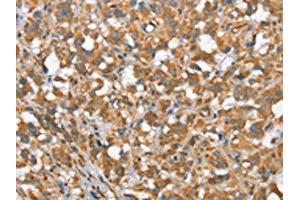 The image on the left is immunohistochemistry of paraffin-embedded Human thyroid cancer tissue using ABIN7190368(CSMD1 Antibody) at dilution 1/40, on the right is treated with synthetic peptide. (CSMD1 antibody)