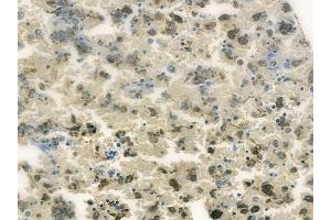 ABIN6260356 and ABIN6278190 at 1/100 staining human melanoma by IHC-P. (BORA antibody  (C-Term))