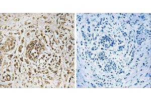 Peptide - +Immunohistochemistry analysis of paraffin-embedded human breast carcinoma tissue, using CIB2 antibody. (CIB2 antibody  (Internal Region))