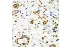 Immunohistochemistry of paraffin-embedded human liver cancer using NRBF2 antibody (ABIN6290681) at dilution of 1:100 (40x lens).