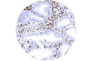 Colon Strong CD7 staining of a large fraction of tumor infiltrating lymphocytes in a colorectal adenocarcinoma. (Recombinant CD7 antibody)
