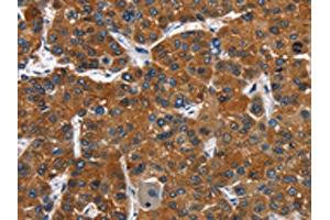 The image on the left is immunohistochemistry of paraffin-embedded Human liver cancer tissue using ABIN7128793(CATSPER3 Antibody) at dilution 1/60, on the right is treated with fusion protein. (CATSPER3 antibody)
