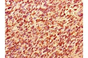 Immunohistochemistry of paraffin-embedded human glioma using ABIN7172435 at dilution of 1:100 (TCEAL8 antibody  (AA 1-117))