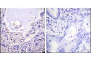 Immunohistochemistry analysis of paraffin-embedded human lung carcinoma tissue, using C-RAF (Ab-621) Antibody.