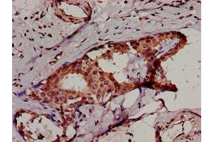 IHC image of ABIN7156261 diluted at 1:500 and staining in paraffin-embedded human breast cancer performed on a Leica BondTM system. (IKBKB antibody  (AA 395-588))