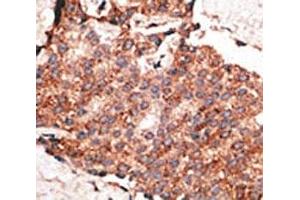 IHC analysis of FFPE human breast carcinoma tissue stained with the BMP1 antibody (BMP1 antibody  (AA 957-986))