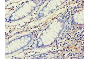 Immunohistochemistry of paraffin-embedded human colon cancer using ABIN7143993 at dilution of 1:100 (AES antibody  (N-Term))