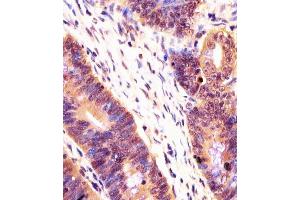 (ABIN6243729 and ABIN6578258) staining PSMB7 in human colorectal carcinoma tissue sections by Immunohistochemistry (IHC-P - paraformaldehyde-fixed, paraffin-embedded sections). (PSMB7 antibody  (AA 180-211))