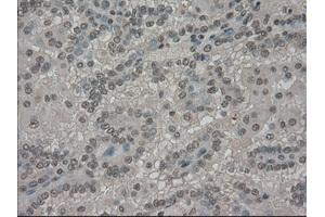 Immunohistochemical staining of paraffin-embedded Carcinoma of kidney tissue using anti-SLC7A8mouse monoclonal antibody. (SLC7A8 antibody)
