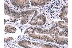 The image on the left is immunohistochemistry of paraffin-embedded Human colon cancer tissue using ABIN7191561(MYF5 Antibody) at dilution 1/15, on the right is treated with synthetic peptide. (MYF5 antibody)