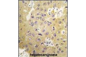 Formalin-fixed and paraffin-embedded human hepatocarcinoma tissue reacted with SGK3 Antibody (N-term) (ABIN392462 and ABIN2842050) , which was peroxidase-conjugated to the secondary antibody, followed by DAB staining.