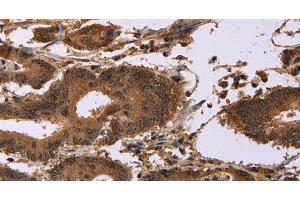 Immunohistochemistry of paraffin-embedded Human colon cancer using EDN2 Polyclonal Antibody at dilution of 1:30 (Endothelin 2 antibody)