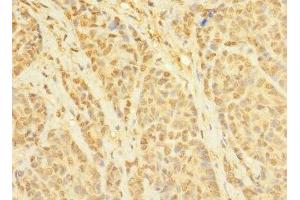 Immunohistochemistry of paraffin-embedded human ovarian cancer using ABIN7171721 at dilution of 1:100 (CCDC79 antibody  (AA 301-550))