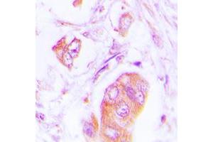 Immunohistochemical analysis of Alpha-adducin staining in human lung cancer formalin fixed paraffin embedded tissue section. (alpha Adducin antibody  (Center))