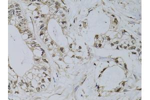 Immunohistochemistry of paraffin-embedded human gastric cancer using PML antibody (ABIN5970530) at dilution of 1/100 (40x lens). (PML antibody)