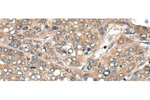 Immunohistochemistry of paraffin-embedded Human liver cancer tissue using ACER1 Polyclonal Antibody at dilution of 1:50(x200) (ACER1 antibody)
