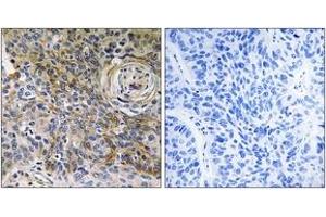 Immunohistochemistry analysis of paraffin-embedded human breast carcinoma tissue, using CD147 Antibody. (CD147 antibody  (AA 336-385))