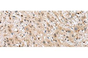 Immunohistochemistry of paraffin-embedded Human liver cancer tissue using TPPP Polyclonal Antibody at dilution of 1:25(x200) (Tppp antibody)