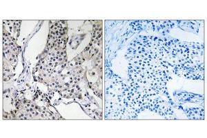 Immunohistochemistry analysis of paraffin-embedded human breast carcinoma tissue using PHLDA3 antibody. (PHLDA3 antibody  (Internal Region))
