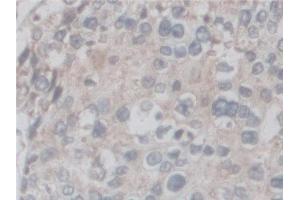 Detection of CF6 in Human Prostate cancer Tissue using Polyclonal Antibody to Coupling Factor 6 (CF6) (ATP5J antibody  (AA 1-108))