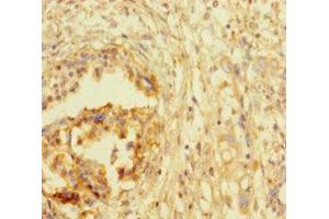 Immunohistochemistry of paraffin-embedded human pancreatic cancer using ABIN7172767 at dilution of 1:100 (ATRX antibody  (AA 2161-2443))