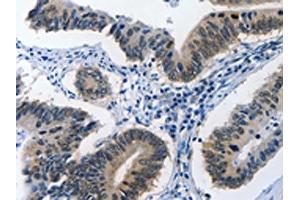 The image on the left is immunohistochemistry of paraffin-embedded Human colon cancer tissue using ABIN7190002(BPIFB1 Antibody) at dilution 1/40, on the right is treated with synthetic peptide. (BPIFB1 antibody)
