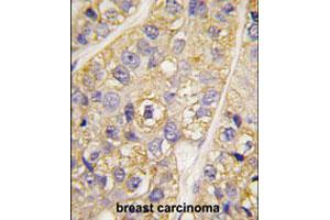 Formalin-fixed and paraffin-embedded human breast carcinoma tissue reacted with PI4K2B polyclonal antibody  , which was peroxidase-conjugated to the secondary antibody, followed by DAB staining. (PI4K2B antibody  (N-Term))