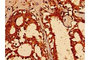 Immunohistochemistry of paraffin-embedded human breast cancer using ABIN7172475 at dilution of 1:100 (TFAP2C antibody  (AA 8-180))