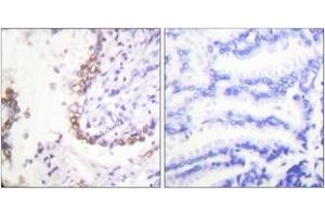 Immunohistochemistry analysis of paraffin-embedded human lung carcinoma tissue, using OCT3 Antibody. (SLC22A8 antibody  (AA 191-240))