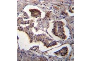 Immunohistochemistry analysis of GUF1 Antibody (N-term) in formalin fixed and paraffin embedded human prostate carcinoma followed by peroxidase conjugation of the secondary antibody and DAB staining. (GUF1 antibody  (N-Term))