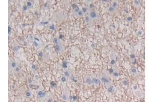 DAB staining on IHC-P; Samples: Human Glioma Tissue (IFNE antibody  (AA 30-208))