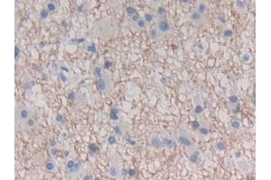 DAB staining on IHC-P; Samples: Human Glioma Tissue
