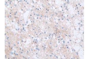 Detection of FBN1 in Human Glioma Tissue using Polyclonal Antibody to Fibrillin 1 (FBN1) (Fibrillin 1 antibody  (AA 723-902))
